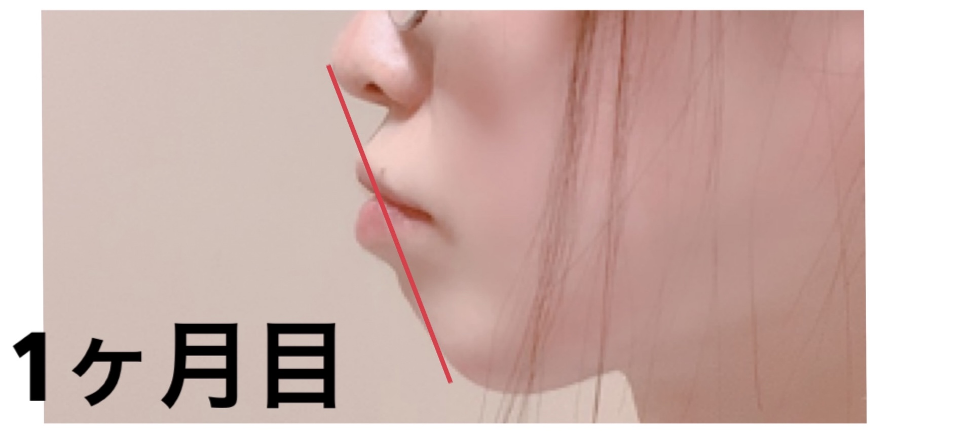 Emi Blog 歯列矯正 横顔の変化 口ゴボ改善１ヶ月目 10ヶ月目